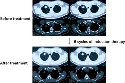 A Dramatic Response to Toripalimab With Chemotherapy and Antiangiogenic Agent Followed by Surgery in a Stage IIIB Lung Adenocarcinoma Patient With an Uncommon EGFR Mutation: A Case Report